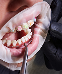 Dental Lasers Manufacturer & Supplier in India